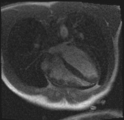 Active right ventricular cardiac sarcoidosis (Radiopaedia 55596-62100 Axial Dynamic perfusion scan MOCO 47).jpg