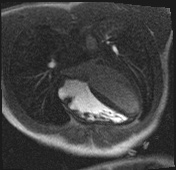 Active right ventricular cardiac sarcoidosis (Radiopaedia 55596-62100 Axial Dynamic perfusion scan MOCO 57).jpg