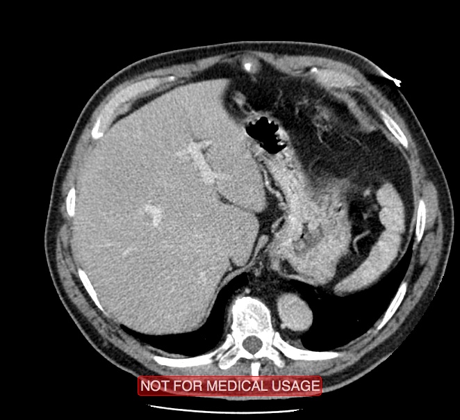 Acute aortic dissection - Stanford type A (Radiopaedia 40661-43285 Axial C+ portal venous phase 61).jpg