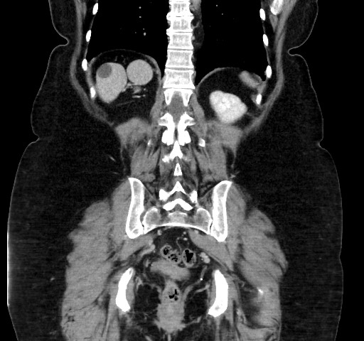 Acute appendicitis, heterotaxy syndrome (Radiopaedia 66884-76202 Coronal C+ portal venous phase 94).jpg