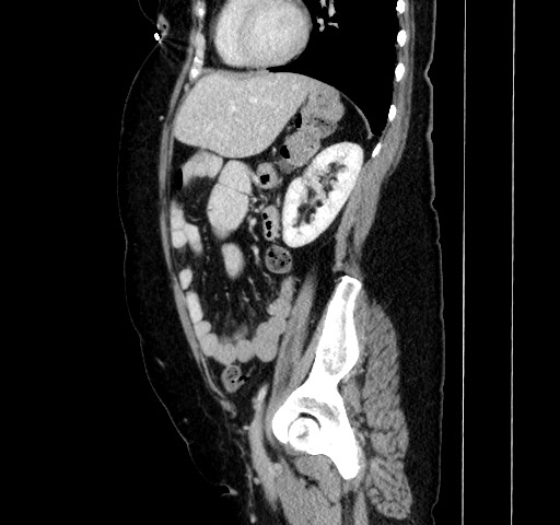 Acute appendicitis, heterotaxy syndrome (Radiopaedia 66884-76202 Sagittal C+ portal venous phase 92).jpg