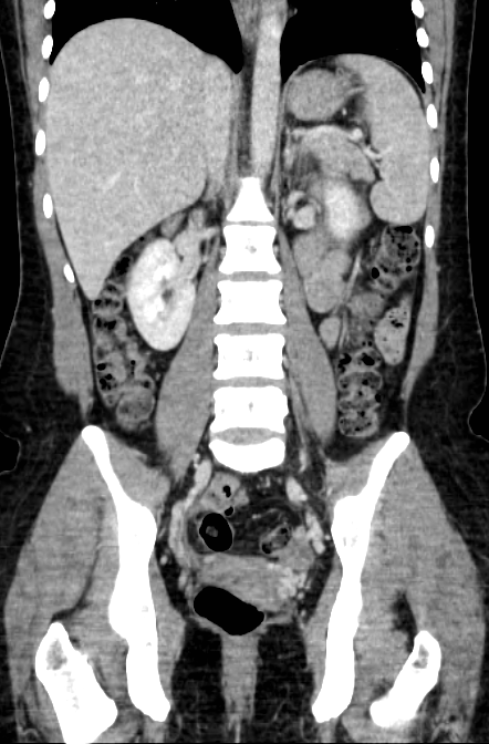 Acute appendicitis (Radiopaedia 22892-22918 Coronal C+ portal venous phase 33).png