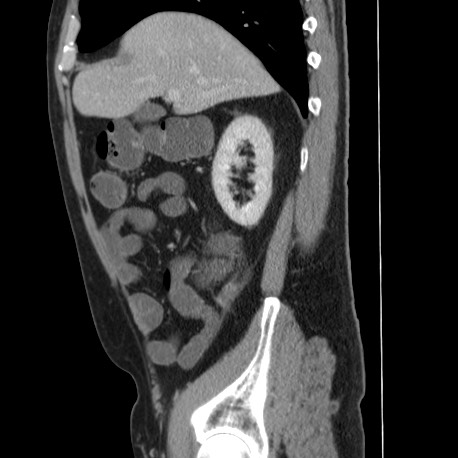 File:Acute appendicitis (Radiopaedia 66513-75790 Sagittal C+ portal venous phase 43).jpg