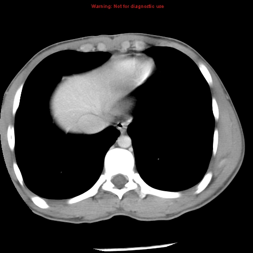Acute appendicitis (Radiopaedia 8195-9045 Axial C+ portal venous phase 6).jpg