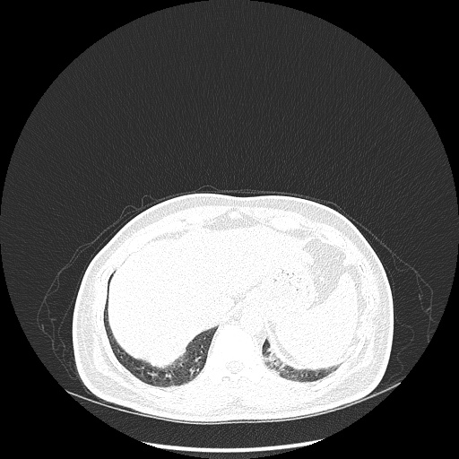 Acute appendicitis and COVID 19 pneumonia (Radiopaedia 76604-88380 Axial lung window 50).jpg