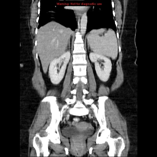 Acute appendicitis complicated by ovarian vein thrombophlebitis (Radiopaedia 16172-15851 Coronal C+ portal venous phase 54).jpg