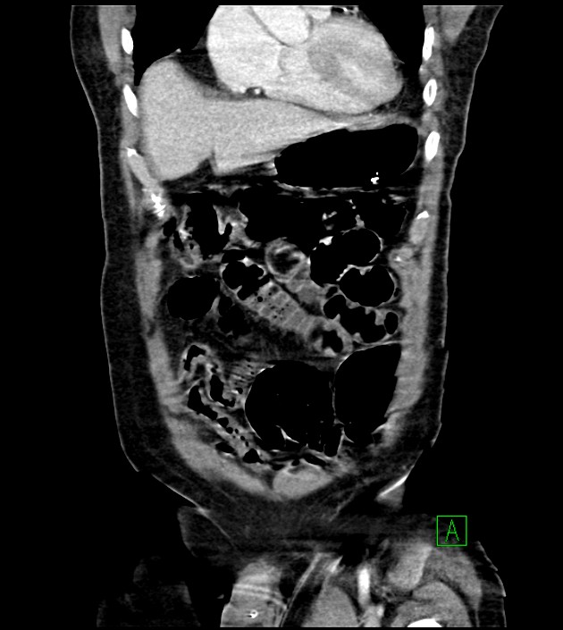 Acute arterial mesenteric ischemia (Radiopaedia 78238-90828 Coronal C+ portal venous phase 27).jpg