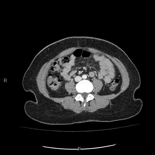 File:Acute bilateral pyelonephritis (Radiopaedia 37146-38881 Axial C+ portal venous phase 62).jpg