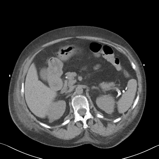 File:Acute bleed from gastric fundus biopsy site (Radiopaedia 35201-36737 Axial non-contrast 26).png