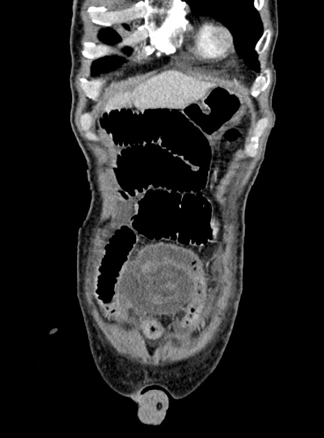 Acute bowel ischemia (Radiopaedia 87695-104114 Coronal C+ portal venous phase 95).jpg