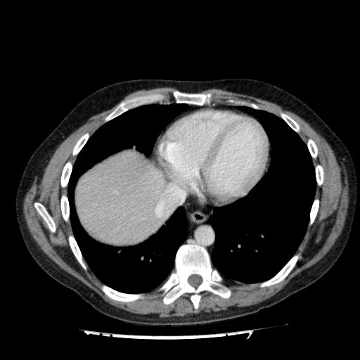 File:Acute cholecystitis and incidental left sided IVC (Radiopaedia 49352-54459 Axial C+ portal venous phase 21).jpg