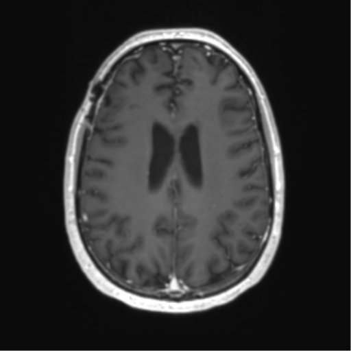 Acute disseminated encephalomyelitis (ADEM) (Radiopaedia 65319-74350 Axial T1 C+ 42).png