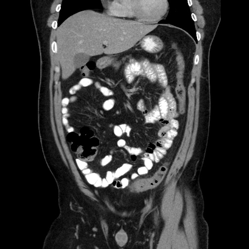 Acute diverticulitis with localized perforation (Radiopaedia 41296-44113 Coronal C+ portal venous phase 25).jpg