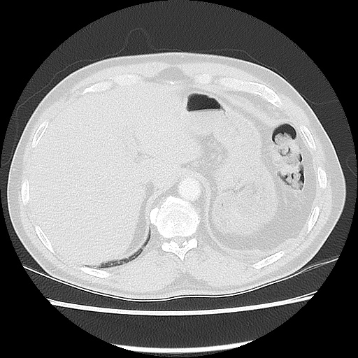 Acute epicardial fat necrosis (Radiopaedia 42327-45440 Axial lung window 51).jpg