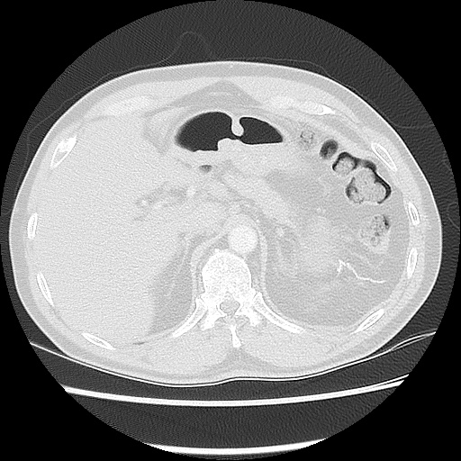 Acute epicardial fat necrosis (Radiopaedia 42327-45440 Axial lung window 54).jpg