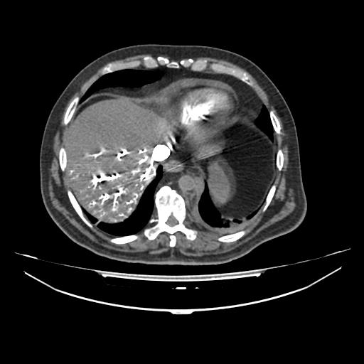 File:Acute heart failure (CT) (Radiopaedia 79835-93075 Axial C+ arterial phase 59).jpg