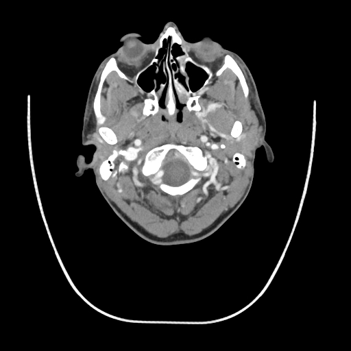 Acute longus colli calcific tendinitis (Radiopaedia 72495-83036 Axial C+ arterial phase 12).jpg