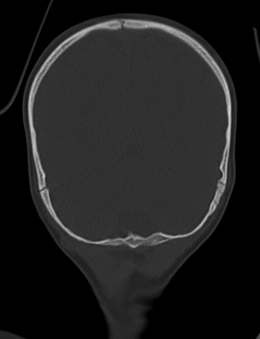 Acute mastoiditis (Radiopaedia 82678-96881 Coronal bone window 64).jpg