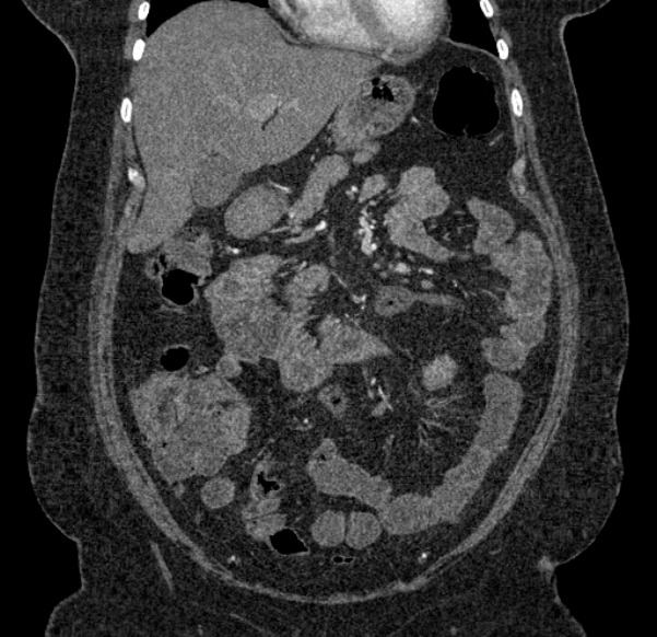 Acute mesenteric ischemia (Radiopaedia 80029-93316 Coronal C+ arterial phase 44).jpg