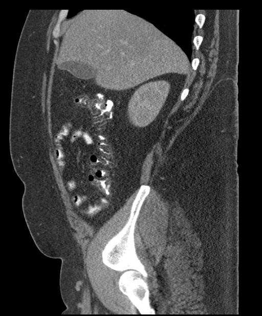 Acute mesenteric venous ischemia (Radiopaedia 46041-50383 Sagittal C+ portal venous phase 27).jpg
