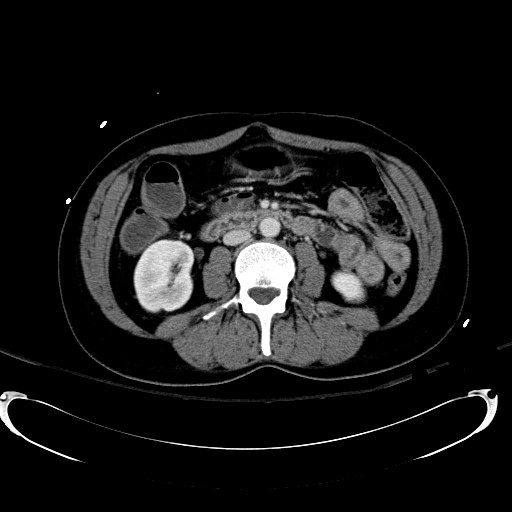 Acute myocardial infarction in CT (Radiopaedia 39947-42415 Axial C+ portal venous phase 64).jpg
