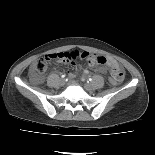 Acute myocarditis (Radiopaedia 55988-62613 Axial C+ portal venous phase 54).jpg