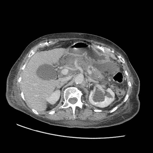 Acute on chronic pancreatitis (Radiopaedia 13233-13244 Axial C+ portal venous phase 31).jpg