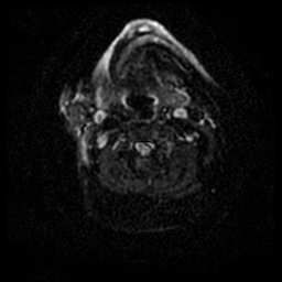 Acute otitis externa (Radiopaedia 57296-64236 Axial DWI 48).jpg