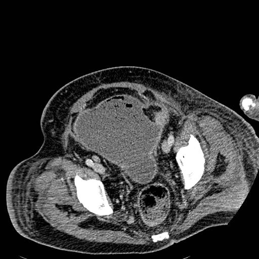 File:Acute pancreatic necrosis (Radiopaedia 13560-18501 Axial C+ portal venous phase 131).jpg