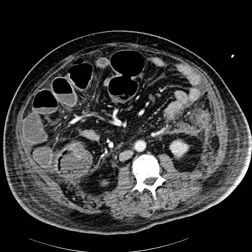 Acute pancreatic necrosis (Radiopaedia 13560-18502 Axial C+ portal venous phase 57).jpg