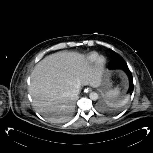 File:Acute pancreatic necrosis (Radiopaedia 13560-18503 Axial C+ portal venous phase 7).jpg