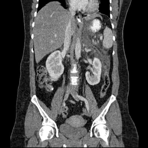 File:Acute pancreatitis (Radiopaedia 20829-20744 Coronal C+ portal venous phase 32).jpg
