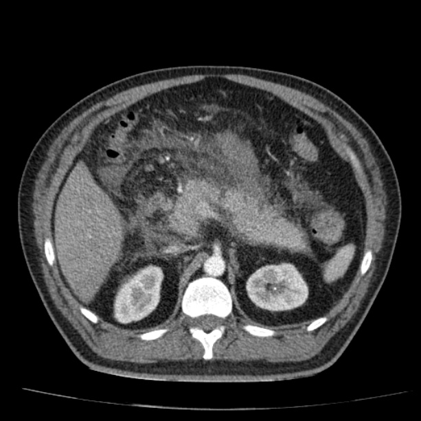 Acute pancreatitis (Radiopaedia 26663-26813 Axial C+ arterial phase 36).jpg