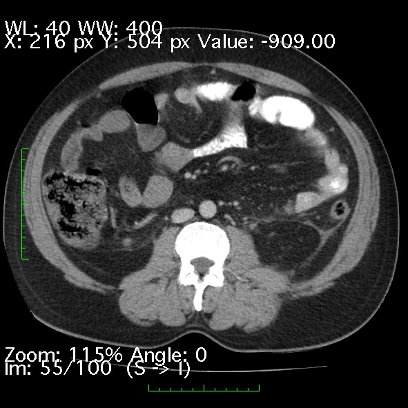 Acute pancreatitis (Radiopaedia 34043-35276 Axial C+ portal venous phase 55).jpg