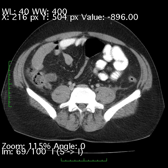 Acute pancreatitis (Radiopaedia 34043-35276 Axial C+ portal venous phase 69).jpg