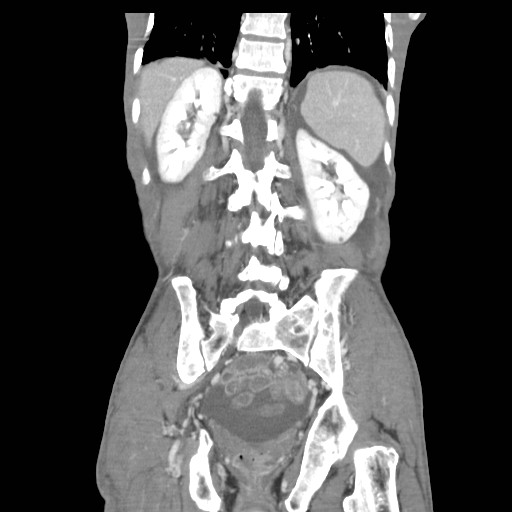 File:Acute pancreatitis (Radiopaedia 50213-55558 Coronal C+ portal venous phase 36).jpg