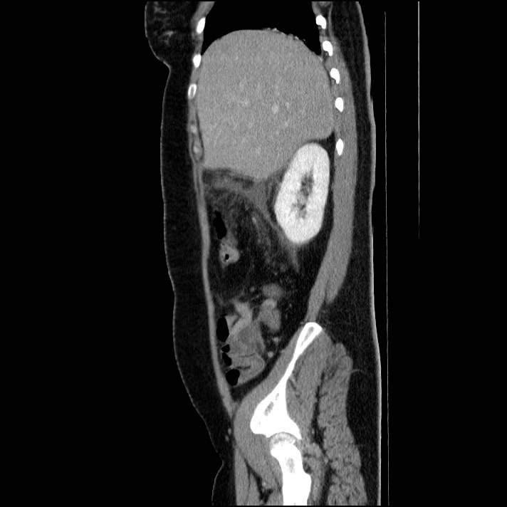 Acute pancreatitis (Radiopaedia 69236-79012 Sagittal C+ portal venous phase 74).jpg