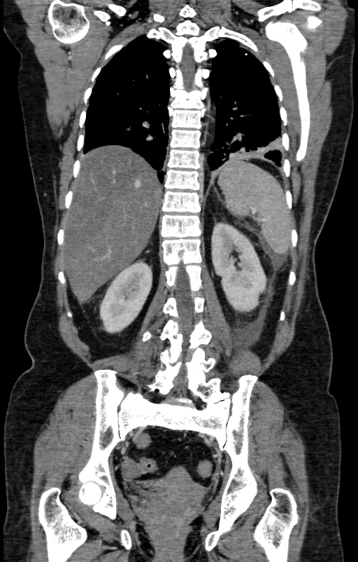 Acute pancreatitis (Radiopaedia 80007-93285 Coronal C+ portal venous phase 116).jpg