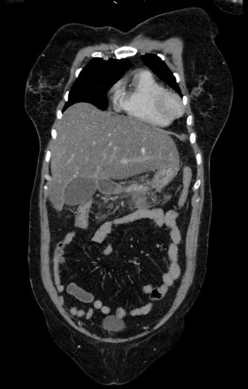Acute pancreatitis (Radiopaedia 80007-93285 Coronal C+ portal venous phase 22).jpg