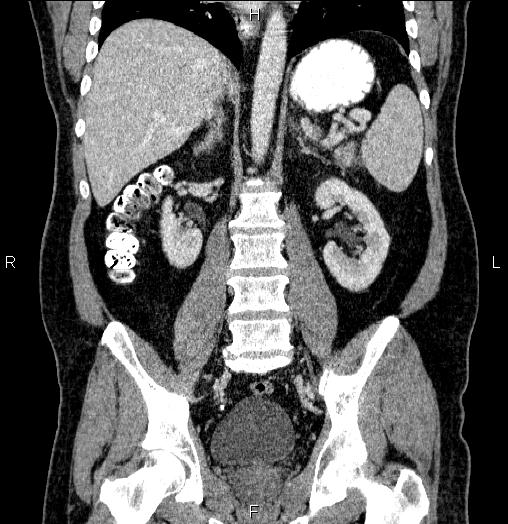 Acute pancreatitis (Radiopaedia 85390-101010 Coronal C+ portal venous phase 45).jpg