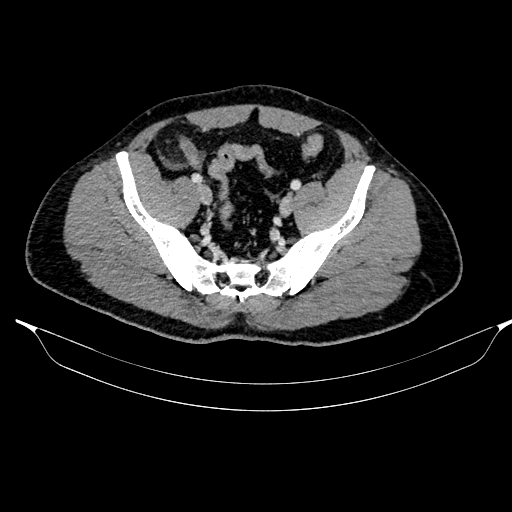 Acute pancreatitis (Radiopaedia 87428-103757 Axial C+ portal venous phase 80).jpg