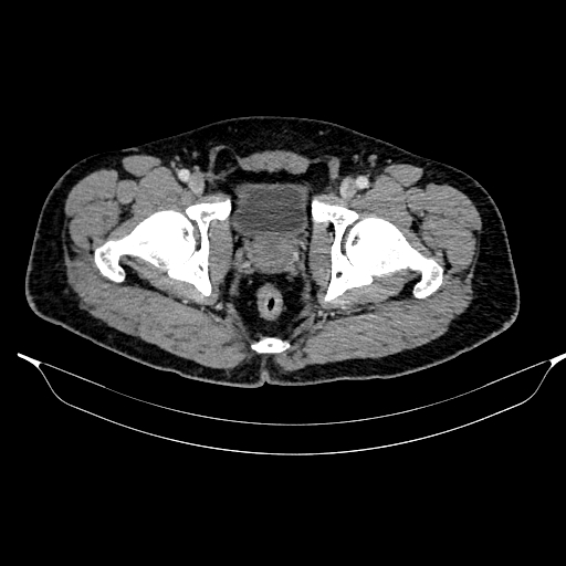 Acute pancreatitis (Radiopaedia 87428-103757 Axial C+ portal venous phase 93).jpg