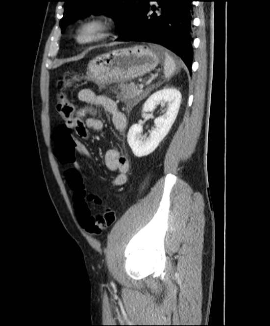 Acute pancreatitis - Balthazar E (Radiopaedia 23080-23110 Sagittal C+ portal venous phase 74).jpg