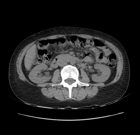 File:Acute pancreatitis - Balthazar E - post ERCP (Radiopaedia 27562-27772 Axial non-contrast 29).png