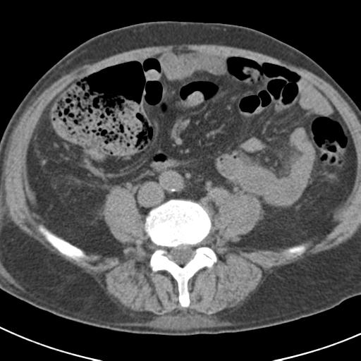 File:Acute pancreatitis and walled-off necrosis (Radiopaedia 29888-30403 Axial non-contrast 46).jpg