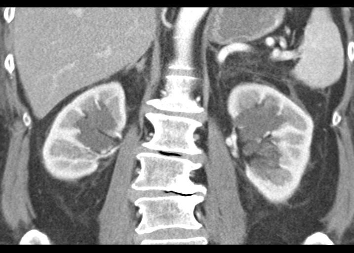 Acute pancreatitis and walled-off necrosis (Radiopaedia 29888-30403 Coronal C+ portal venous phase 38).jpg