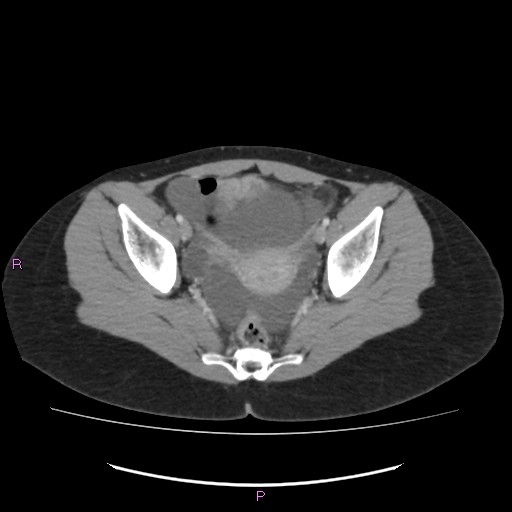 Acute pancreatitis secondary to stone at minor papilla and pancreatic divisum (Radiopaedia 76570-88333 Axial C+ portal venous phase 69).jpg