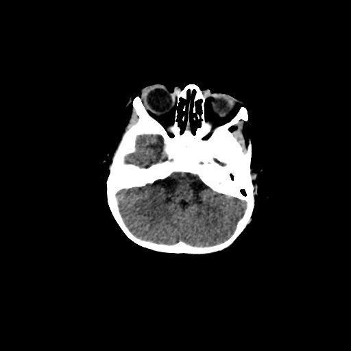 Acute phase of hemiconvulsion-hemiplegia epilepsy syndrome (Radiopaedia 29309-29744 Axial non-contrast 42).jpg