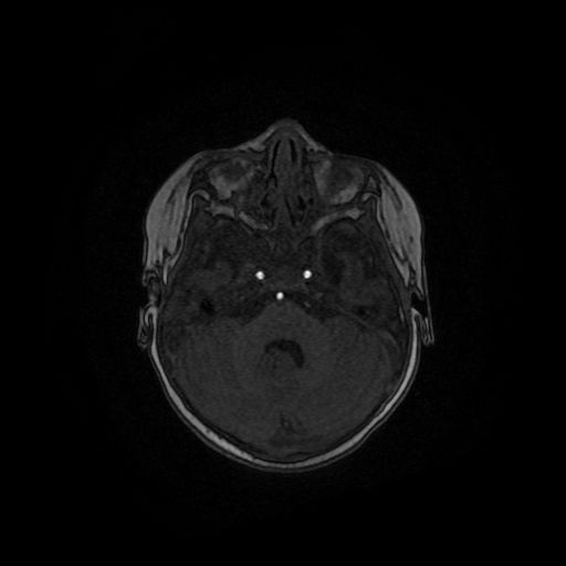 Acute phase of hemiconvulsion-hemiplegia epilepsy syndrome (Radiopaedia 29309-29745 Axial TOF angiography 112).jpg