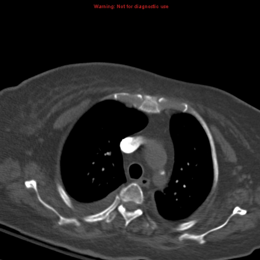 File:Acute pulmonary embolism (Radiopaedia 13286-13289 Axial C+ CTPA 19).jpg